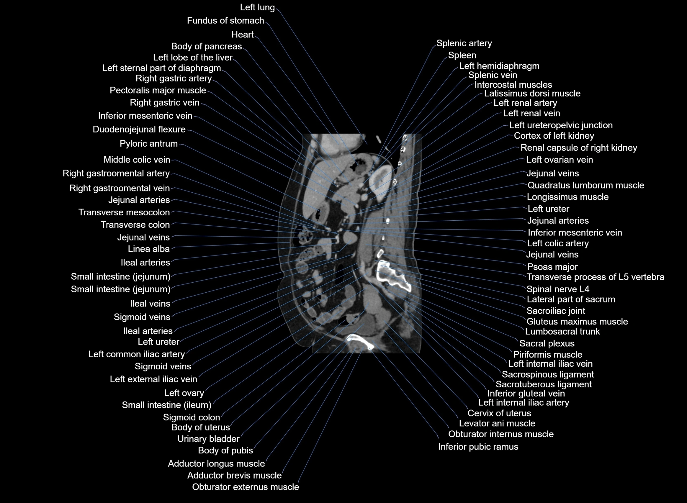 CT Abdomen sagittal cross sectional anatomy labelled radiology image -00048.webp